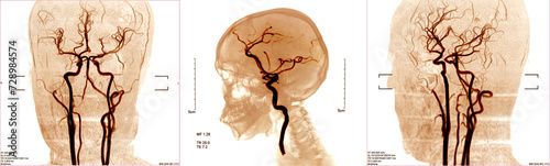 Fotografie blood vessels x-ray images in the brain for diagnose cerebrovascular disease or hemorrhagic stroke