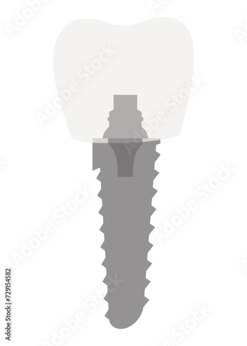 Dental implant structure. Medical educative infographic poster. Teeth implant, realistic vector design of dentistry. Implant screw, healthcare, dentist and orthodontist treatment