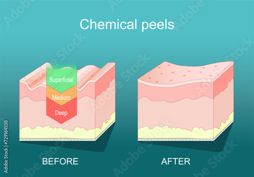 Chemical peel. Beauty aesthetic treatment