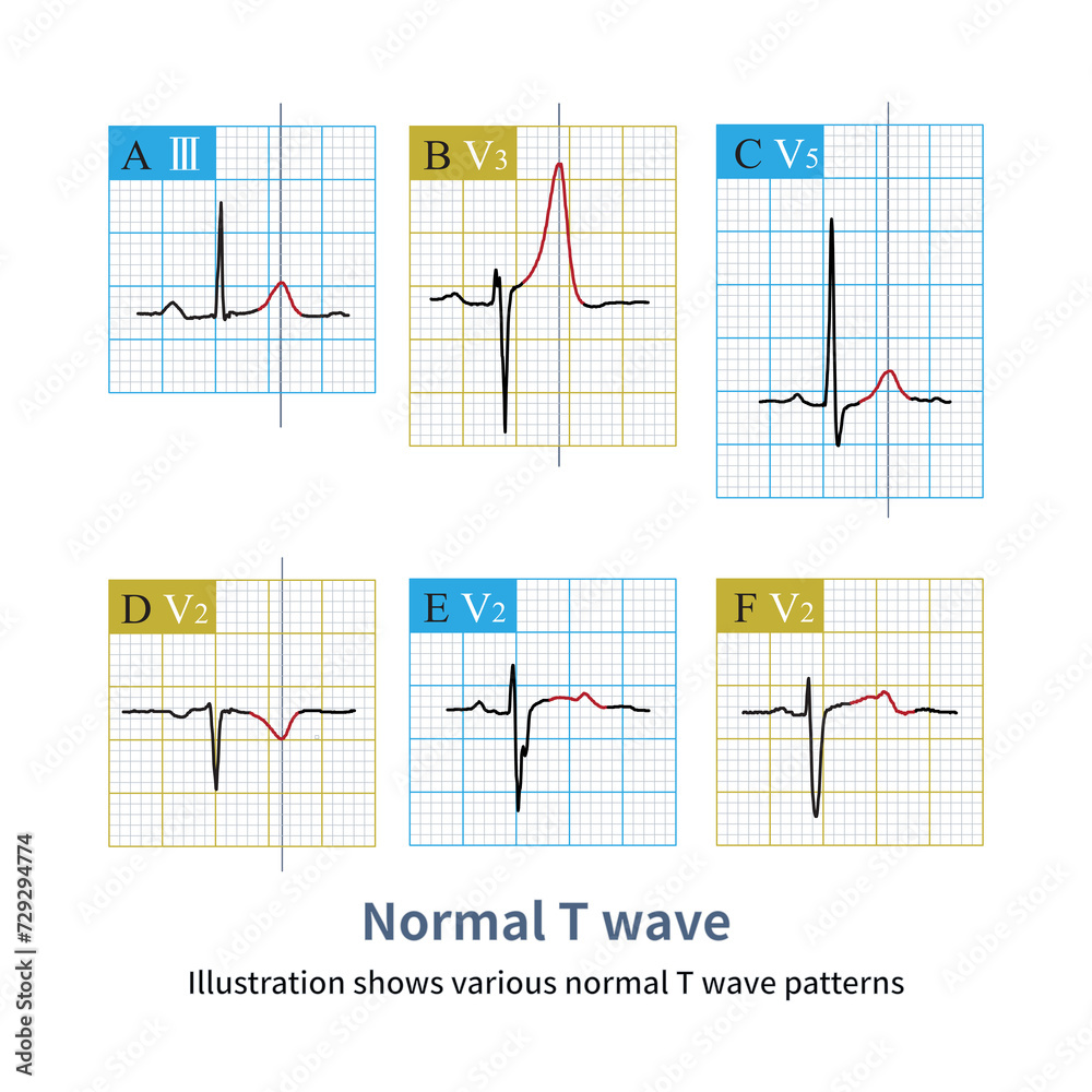 There are many morphologies of normal T waves, and some are tall, low ...