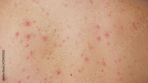 Back of adult have spotted, red pimple and bubble rash from chickenpox or varicella zoster virus photo