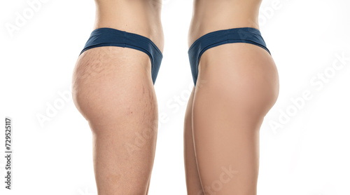 Comparison before and after woman's hips with stretch marks removal treatment on a white background