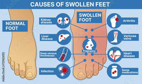 Causes of swollen feet. Healthcare infographic, educational illustration. Vector illustration. 