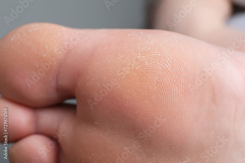 Woman with dry skin on foot, closeup
