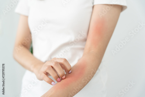skin problem and beauty. Young woman scratch body has itchy skin from skin allergic, steroid allergy, sensitive skin, red from sunburn, chemical allergy, rash, insect bites, Seborrheic Dermatitis. © Shisu_ka