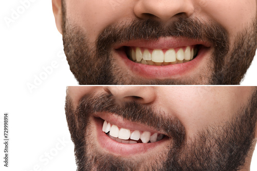 Man showing teeth before and after whitening on white background, collage