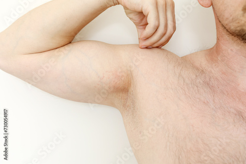 Allergy underarm. Cropped photo of irritation, inflammation on the sensitive skin after using a razor, trimmer, toxic deodorant or antiperspirant. Armpit rash. Atopic dermatitis. Acne or red spots.