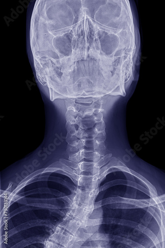 X-ray of AP head and AP cervical vertebrae on black background.
