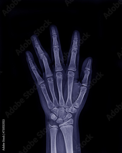 X-ray picture of fracture of hand and ring finger caused by accident