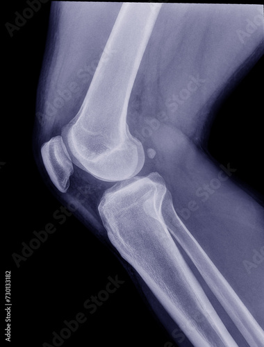 Knee x-ray image of a woman on the side with severe knee pain