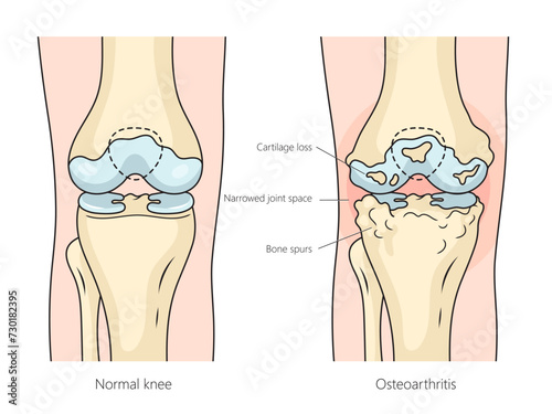 Human Osteoarthritis Rheumatoid arthritis of knee joint structure diagram hand drawn schematic vector illustration. Medical science educational illustration