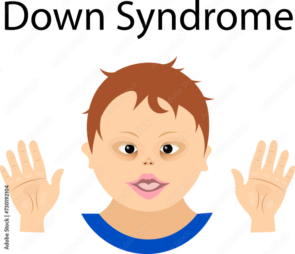 World Down syndrome day. Boy with Down syndrome and two palms. Down syndrome awareness concept. World Down syndrome day. Boy with Down syndrome and two palms. Down syndrome awareness concept.