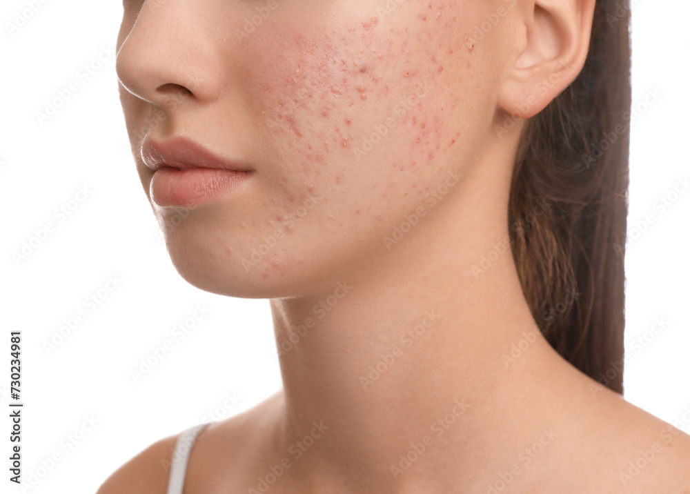 Teenage girl with acne problem on white background, closeup Teenage girl with acne problem on white background, closeup