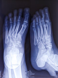X-ray of foot both view. Normal radiograph.