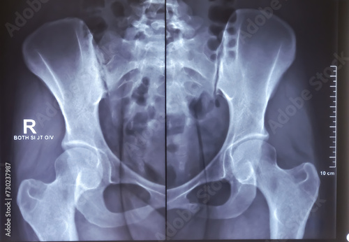 X-ray image of female pelvic. Scleroses are noted at the articular margins of both SI joints. photo