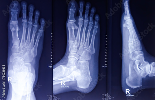 X-ray of foot both view. Fracture is noted at proximal phalanx on 4th toe. Soft tissue swelling. photo