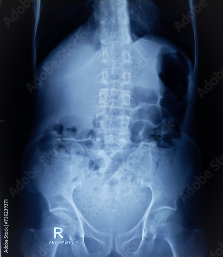 Plain X-ray of Abdomen in erect posture. Large bowel loops are distended with gas and loaded faecal matters. photo
