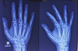 X-ray of human hand. X-ray of hand bones. Normal findings, no significant skeletal abnormality detected.