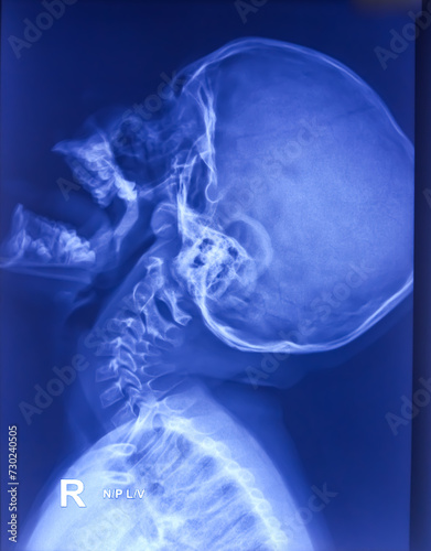 X-ray of nasopharynx lateral view show Enlarged adenoid. Small lobulated dense homogeneous opacity having convex anterior margin. Hicrontrast BW adjust. photo