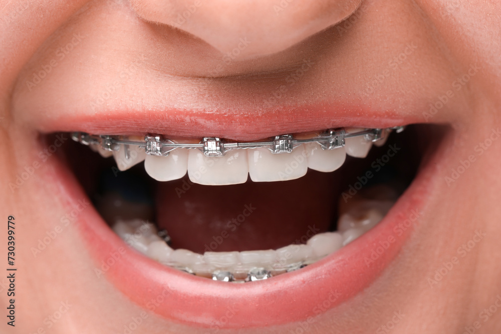 Obraz premium Happy woman with dental braces, closeup view