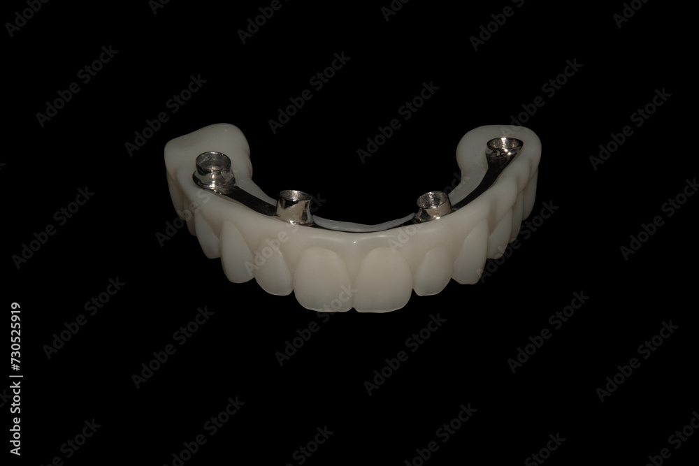 Hybrid Prosthesis: Dental Implants with Metal Bar and 3D-Printed Structure. Hybrid Prosthesis: Dental Implants with Metal Bar and 3D-Printed Structure.