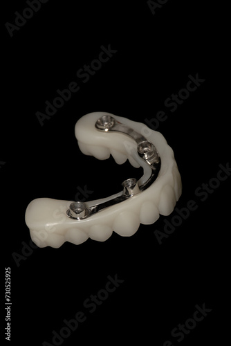 Hybrid Prosthesis: Dental Implants with Metal Bar and 3D-Printed Structure.
