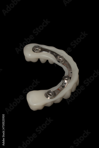 Hybrid Prosthesis: Dental Implants with Metal Bar and 3D-Printed Structure.