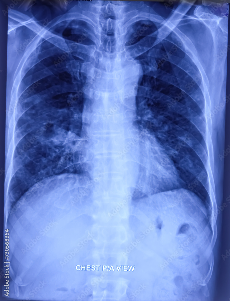 CXR (X-ray of chest) PA view. Pulmonary tuberculosis with pneumonia. Non homogeneous opacities are noted in both lower zones. pulmonary inflammatory lesion (bilateral).