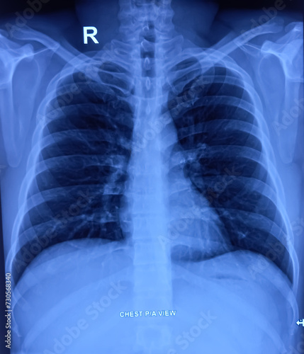 CXR PA view. Chest X-ray rediograph. PA view. Normal findings. photo