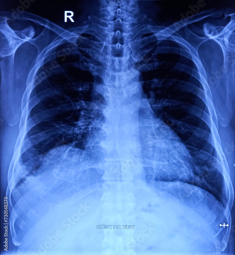 CXR (X-ray of chest) PA view. Non homogeneous opacities are noted in both lower zones. pulmonary inflammatory lesion (bilateral). photo