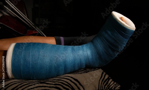 Obraz na plátně Closeup of a person's leg in a cast due to a fracture.