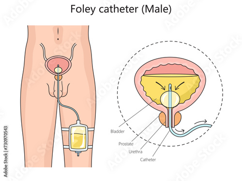 Male foley urinary catheter structure diagram hand drawn schematic vector illustration. Medical science educational illustration