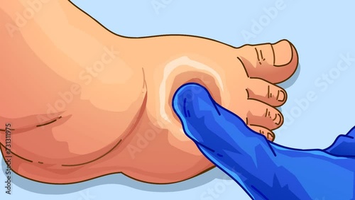 Swollen foot. Рhysical exam checks health. Before, after. Pitting edema.  Healthcare video. photo