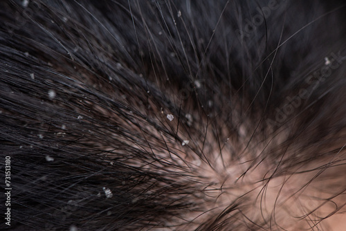 Woman with dandruff in her dark hair, closeup view © zhikun sun