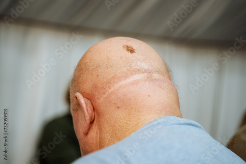 Close up of the back of a mans head with a shaved crown and a scar from surgery or injury.