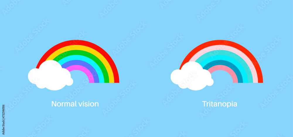 tritanopia and tritanomaly tritanopia and tritanomaly