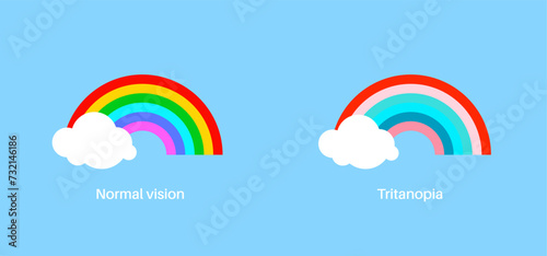 tritanopia and tritanomaly
