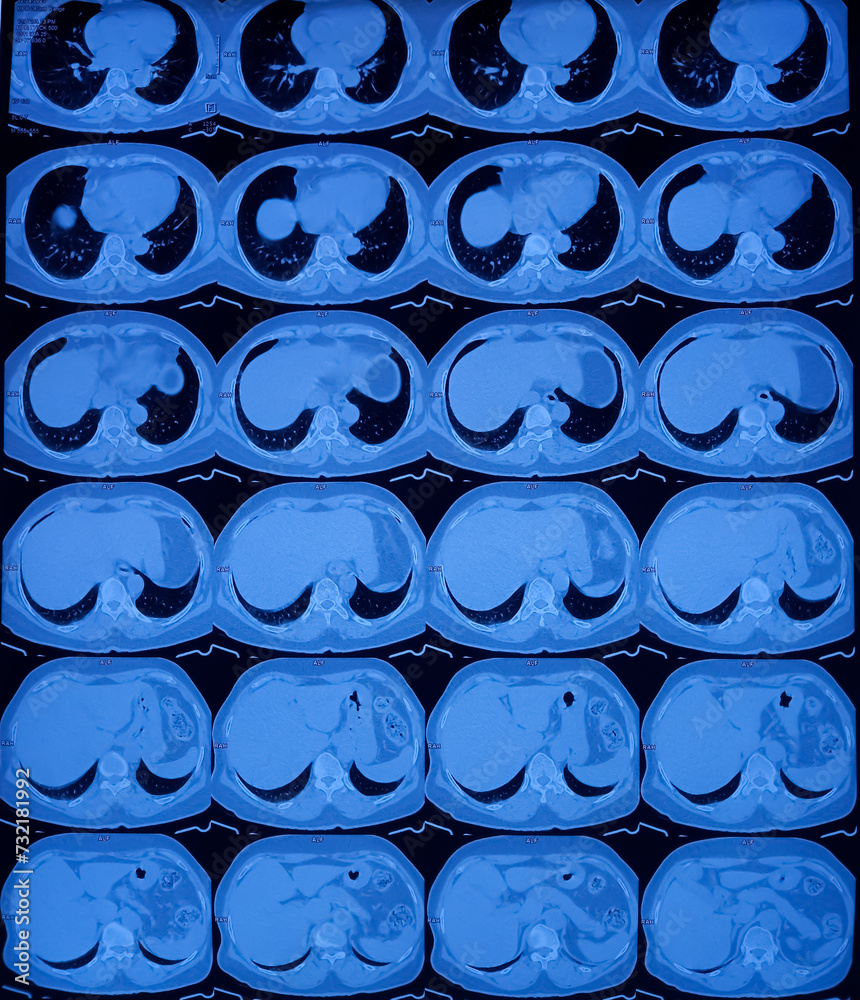 Multi Slice HRCT Scan Of Chest Prominent Broncho Vascular Markings In Multi Slice HRCT Scan Of Chest Prominent Broncho Vascular Markings In