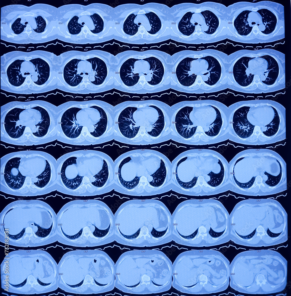 multi-slice-hrct-scan-of-chest-prominent-broncho-vascular-markings-in