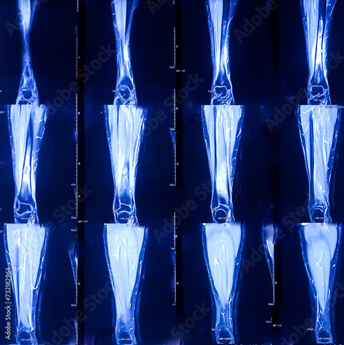 Fotografie MRI (Magnetic resonance imaging) scan of leg