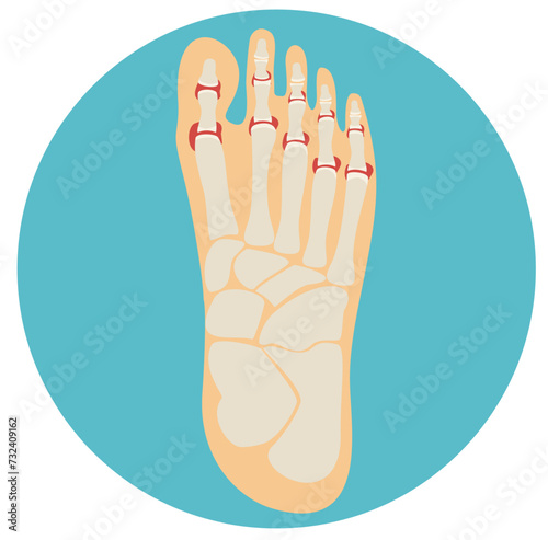 Rheumatoid arthritis of the toes. Arthritis of the leg. Medicine education. Anatomy of joints and bones. Vector illustration