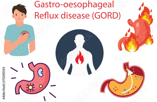 Gastro-oesophageal reflux disease (GORD),the stomach acid leak,heartburn,burning sensation in the chest,tomach acid comes back,bloating and belching,Gastroenteritis,Intestinal flu,stomach ache,five