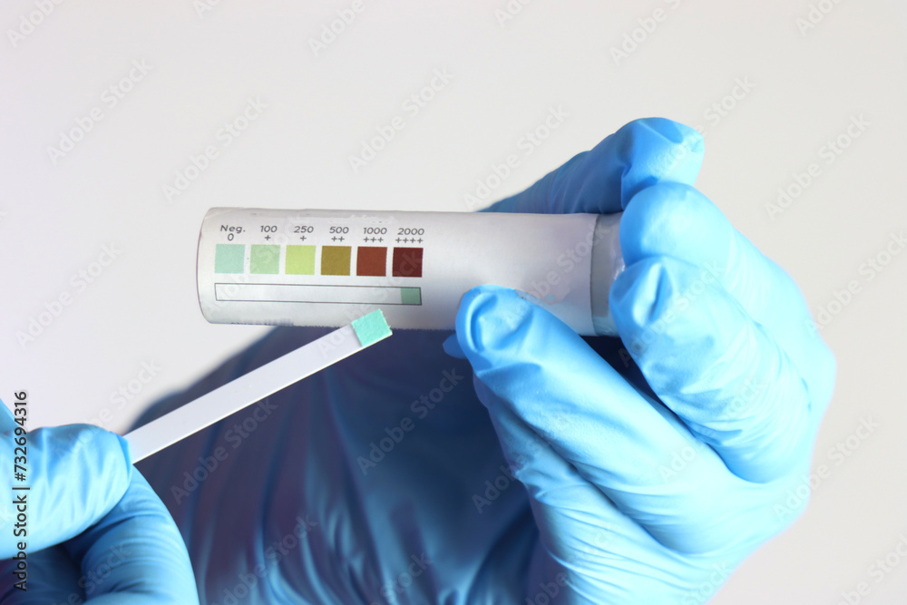 Glucose urinary test in a health care professional hands beeing showed to te camera Glucose urinary test in a health care professional hands beeing showed to te camera