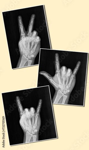 Film xray x-ray or radiograph of a hand and fingers showing the peace hippie 1960s groovy sign or V, I love you, rock on devil horn.  aka peace, love and rock n roll.  isolated on white background photo