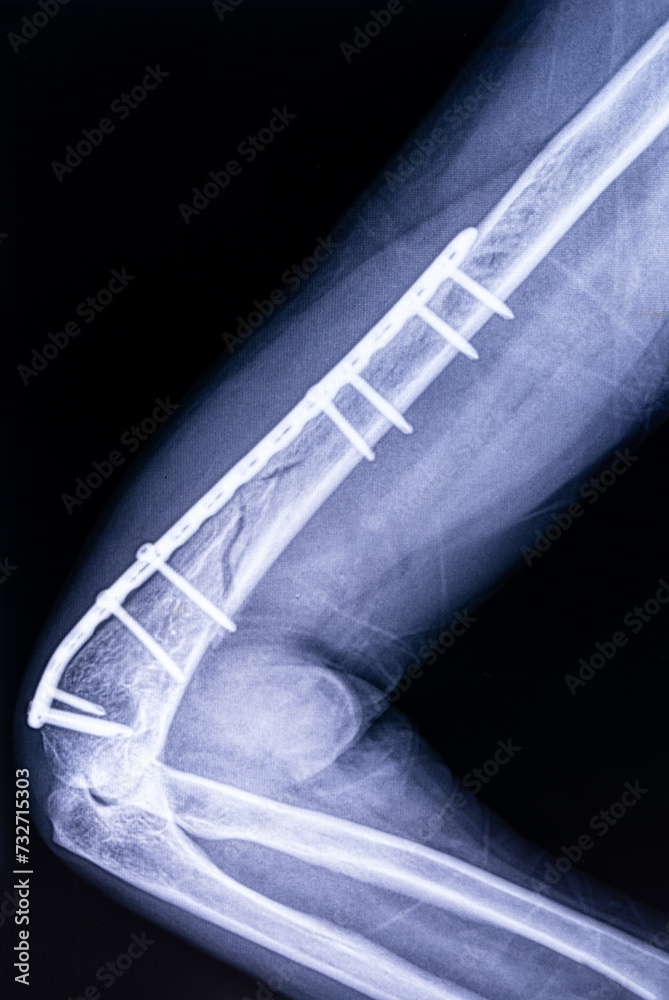 X-ray image of hand osteosynthesis