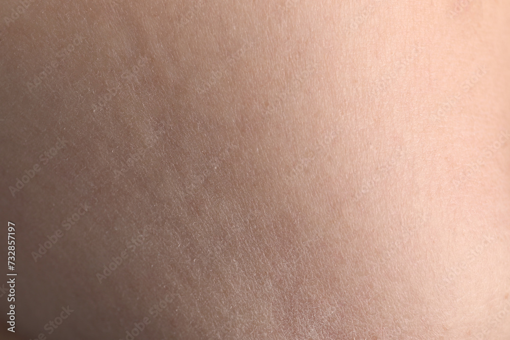 Closeup view of woman with dry skin Closeup view of woman with dry skin