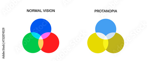 Protanomaly and protanopia