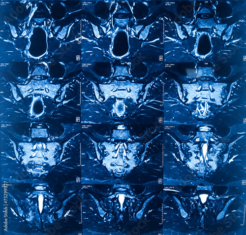 MRI (magnetic resonance imaging) of Lumbo sacral Spine. Degenerative change in lumber spine. Osteophytic change. photo