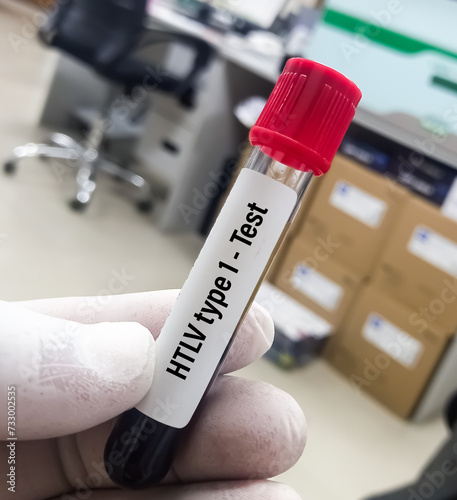 Blood sample for Human T-lymphotropic virus or Human T-cell leukaemia virus or HLTV type 1 test, to diagnose a type of cancer called adult T-cell leukaemia or Lymphoma. photo