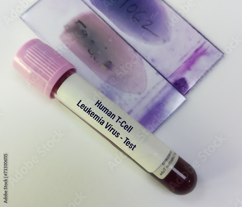 Blood sample for Human T-lymphotropic virus or Human T-cell leukemia virus or HLTV test, to diagnose a type of cancer called adult T-cell leukemia or Lymphoma. photo